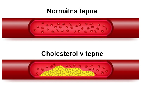 Cholesterol v tepne