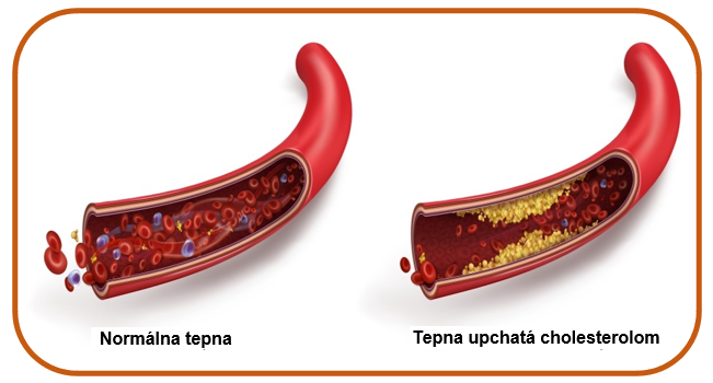 Tepna upchatá cholesterolom